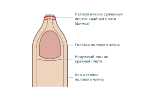 Схема фимоза: суженное отверстие крайней плоти, под ней головка полового члена